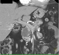 Intraductal Papillary Mucinous Neoplasm (IPMN) - CTisus CT Scan