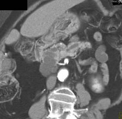 Intraductal Papillary Mucinous Neoplasm (IPMN) - CTisus CT Scan