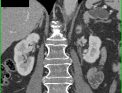 Intraductal Papillary Mucinous Neoplasm (IPMN) - CTisus CT Scan