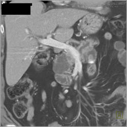 Intraductal Papillary Mucinous Neoplasm (IPMN) - CTisus CT Scan