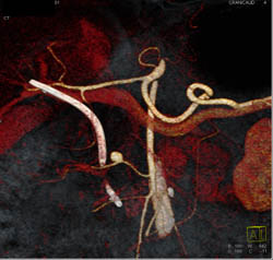 1 Cm Aneurysm Off A Branch of the SMA - CTisus CT Scan