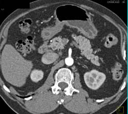 Intraductal Papillary Mucinous Neoplasm (IPMN) - CTisus CT Scan