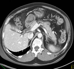 1 Cm Islet Cell Off Tail of Pancreas - CTisus CT Scan