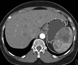 Lymphoma Involves Spleen and Pancreas - CTisus CT Scan