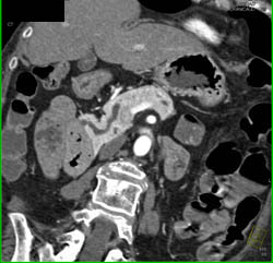 Mild Dilation Pancreatic Duct - CTisus CT Scan