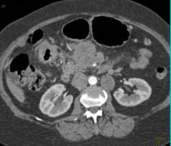 Pancreatic Cancer Encases the Celiac Axis - CTisus CT Scan