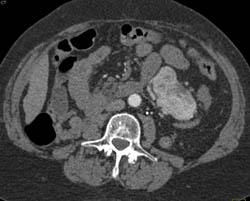 Islet Cell Tumor - CTisus CT Scan