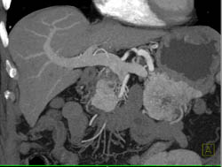 Islet Cell Tumor - CTisus CT Scan