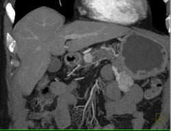 Islet Cell Tumor - CTisus CT Scan