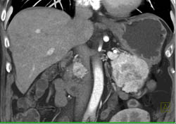 Islet Cell Tumor - CTisus CT Scan