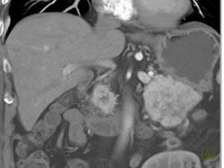 Islet Cell Tumor - CTisus CT Scan