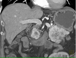 Islet Cell Tumor - CTisus CT Scan