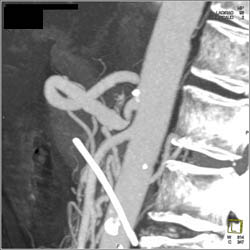 Celiac Stenosis With Stent in Distal Duct - CTisus CT Scan