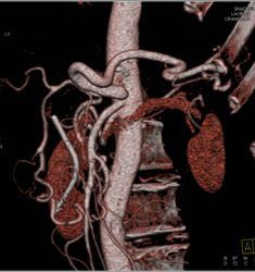 Intraductal Papillary Mucinous Neoplasm (IPMN) - CTisus CT Scan