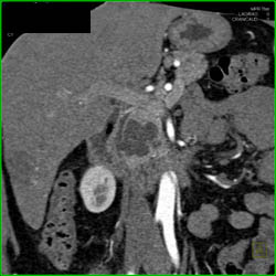 Intraductal Papillary Mucinous Neoplasm (IPMN) - CTisus CT Scan