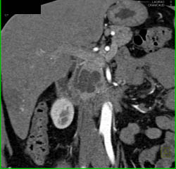 Intraductal Papillary Mucinous Neoplasm (IPMN) - CTisus CT Scan