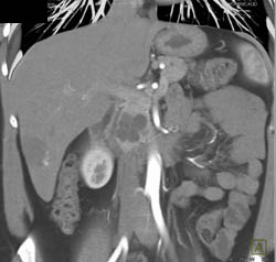 Intraductal Papillary Mucinous Neoplasm (IPMN) - CTisus CT Scan