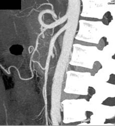 Intraductal Papillary Mucinous Neoplasm (IPMN) - CTisus CT Scan