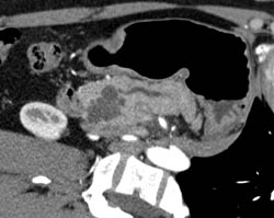 Intraductal Papillary Mucinous Neoplasm (IPMN) - CTisus CT Scan