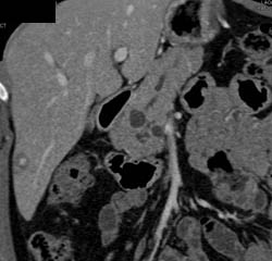 Intraductal Papillary Mucinous Neoplasm (IPMN) - CTisus CT Scan