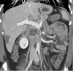 Intraductal Papillary Mucinous Neoplasm (IPMN) - CTisus CT Scan