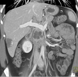 Intraductal Papillary Mucinous Neoplasm (IPMN) - CTisus CT Scan