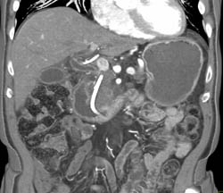 Islet Cell of the Pancreas - CTisus CT Scan