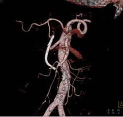 Carcinoma Head of Pancreas With Dilated Pancreatic Duct and Stent in Common Bile Duct (CBD) - CTisus CT Scan