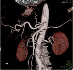 Hepatic and Splenic Arteries Arise Directly Off Aorta - CTisus CT Scan