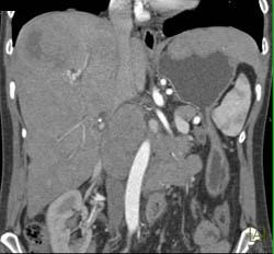 Islet Cell Tumor- Avascular- With Necrotic Liver Metastases - CTisus CT Scan