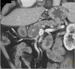 Serous Cystadenoma - CTisus CT Scan