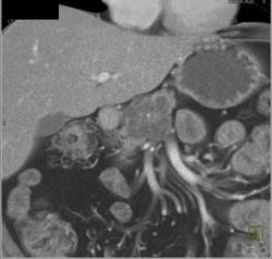 Serous Cystadenoma - CTisus CT Scan