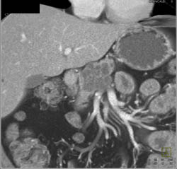 Serous Cystadenoma - CTisus CT Scan