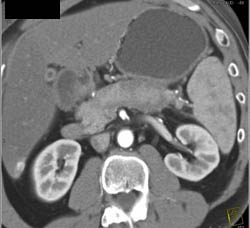 Hemorrhagic Pancreatitis - CTisus CT Scan