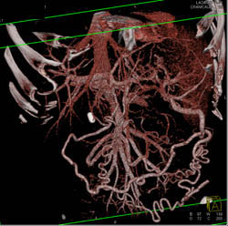 Pancreatic Cancer Encases PV/SMV/splenic Vein With Extensive Collaterals - CTisus CT Scan