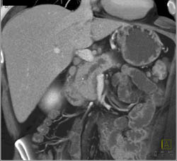 Dilated Pancreatic Duct Due to Chronic Pancreatitis - CTisus CT Scan