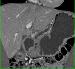 5 Mm Islet Cell Tumor in Distal Pancreatic Duct - CTisus CT Scan