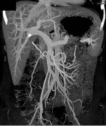 Portal Venous Mapping - CTisus CT Scan