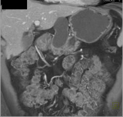 Cystadenoma - CTisus CT Scan