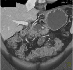 Cystadenoma - CTisus CT Scan