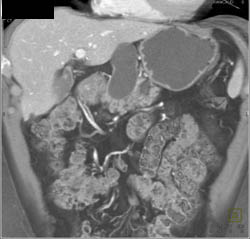 Cystadenoma - CTisus CT Scan