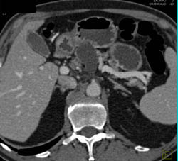 Cystadenoma - CTisus CT Scan