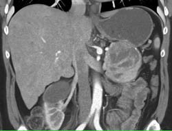 Islet Cell Tumor - CTisus CT Scan