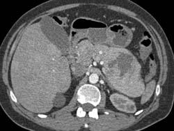 Islet Cell Tumor - CTisus CT Scan