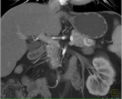 Islet Cell Tumor - CTisus CT Scan