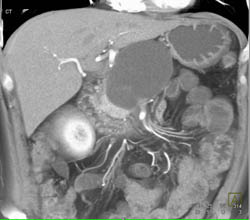 Serous Cystadenoma - CTisus CT Scan