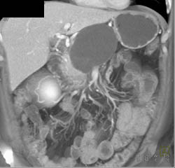 Serous Cystadenoma - CTisus CT Scan