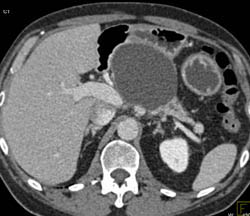 Serous Cystadenoma - CTisus CT Scan