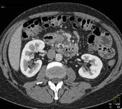 Serous Cystadenoma - CTisus CT Scan