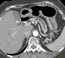 Dilated Pancreatic Duct Due to Mucinous Cystadenoma - CTisus CT Scan